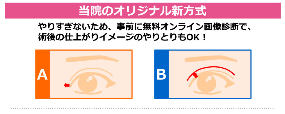 目頭切開