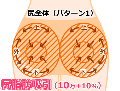 尻脂肪吸引