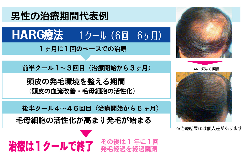 男性の治療期間代表例 HARG療法 1クール(6回 6ヶ月)