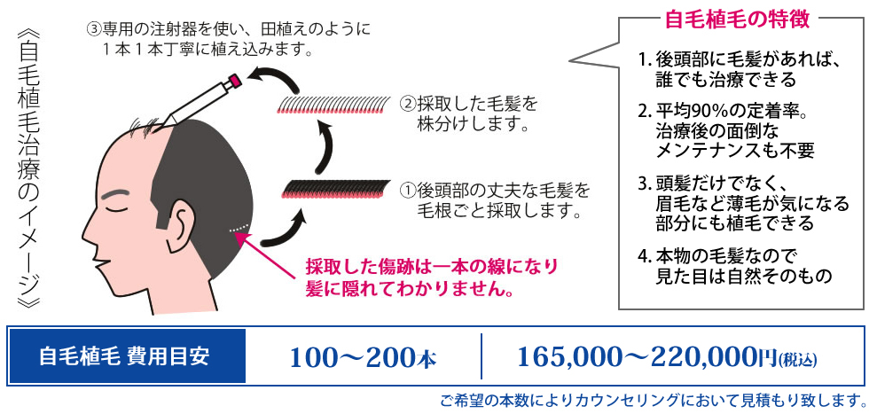 自毛植毛治療のイメージ 自毛植毛の特徴 1.後頭部に毛髪はあれば誰でも治療ができる 2.平均90%の定着率。治療後の面倒なメンテナンスも不要 3.頭皮だけでなく、眉毛など薄毛が気になる部分にも植毛できる 4.本物の毛髪なので見た目は自然そのもの