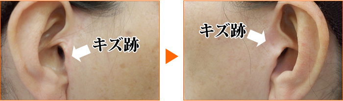 リフト症例　傷痕