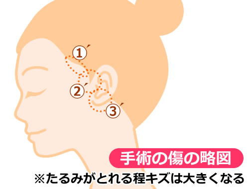 若返りリフト手術の略図