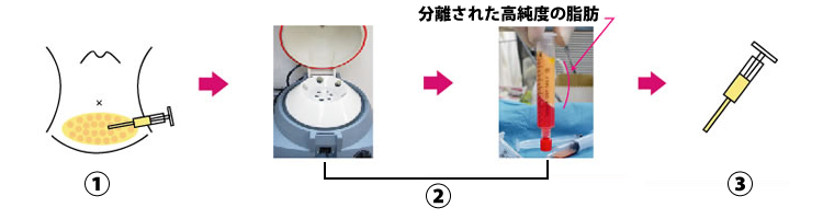 亀頭増大 脂肪採取から注入まで